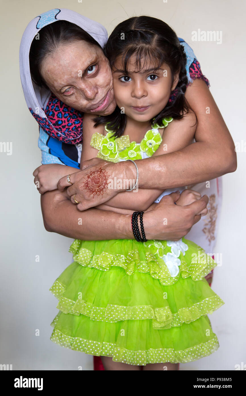 Soniya, Opfer der Säureangriff in Delhi (von Stop die Säure greift Kampagne, Indien) Stockfoto