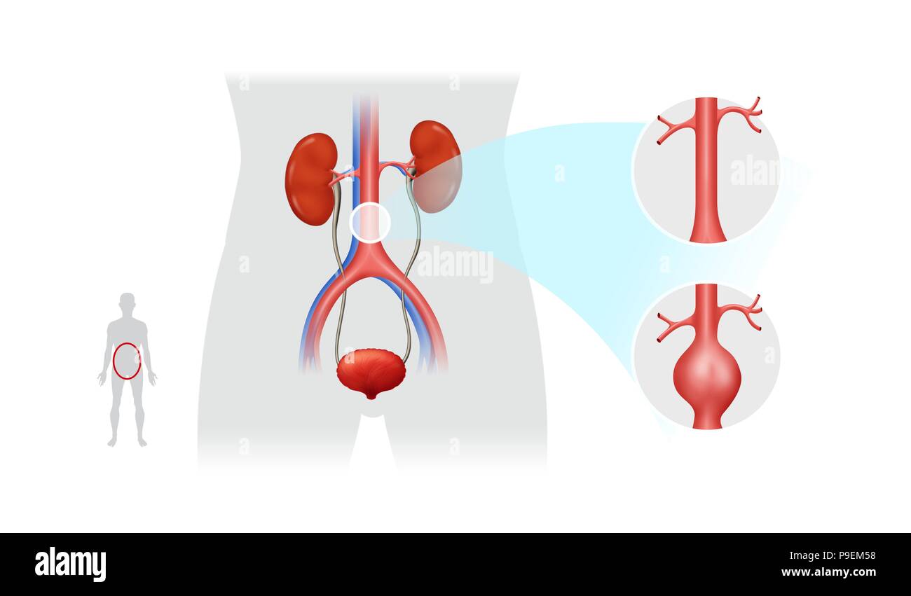 Abdominal aorta -Fotos und -Bildmaterial in hoher Auflösung – Alamy
