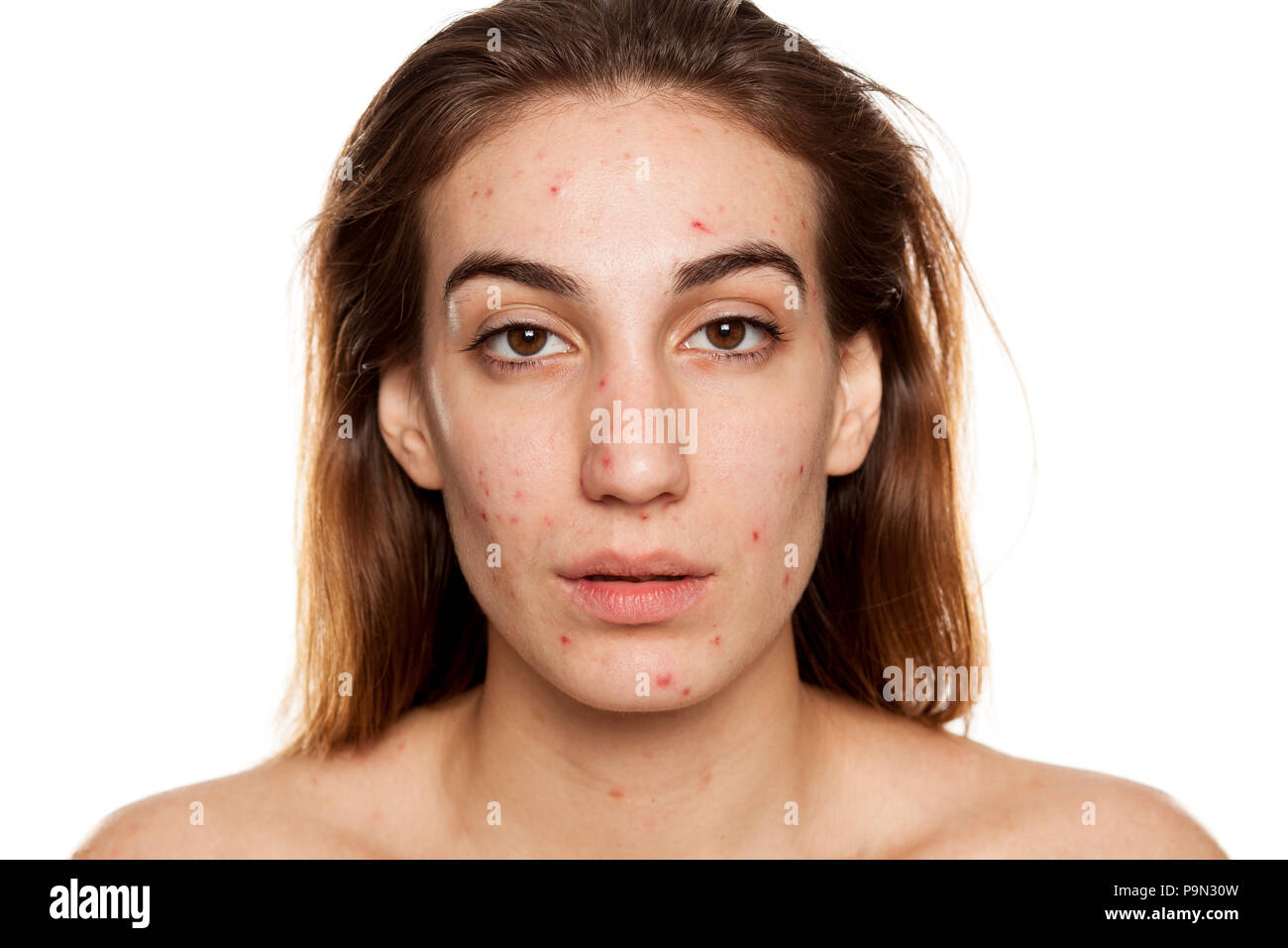 Junge Frau mit problematischer Haut und ohne Make-up Posen auf weißem Hintergrund Stockfoto