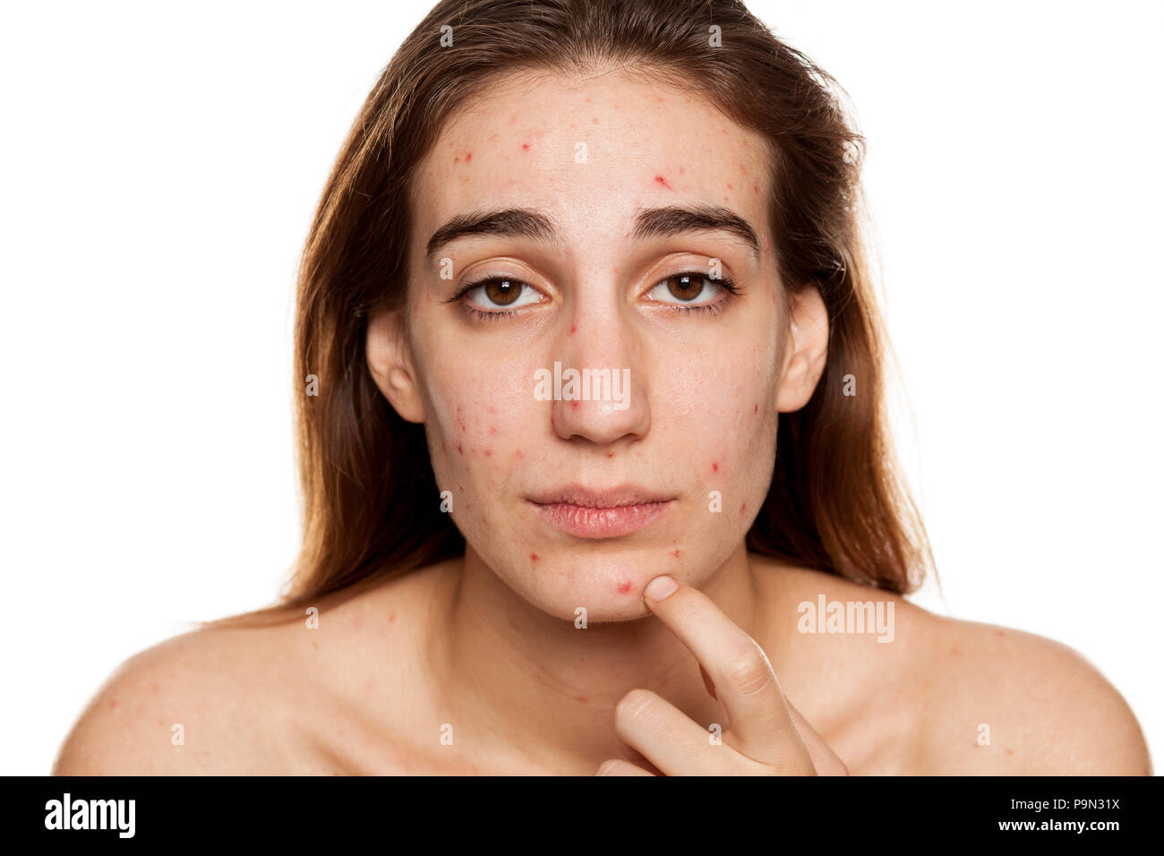 Junge Frau mit problematischer Haut und ohne Make-up Posen auf weißem Hintergrund Stockfoto