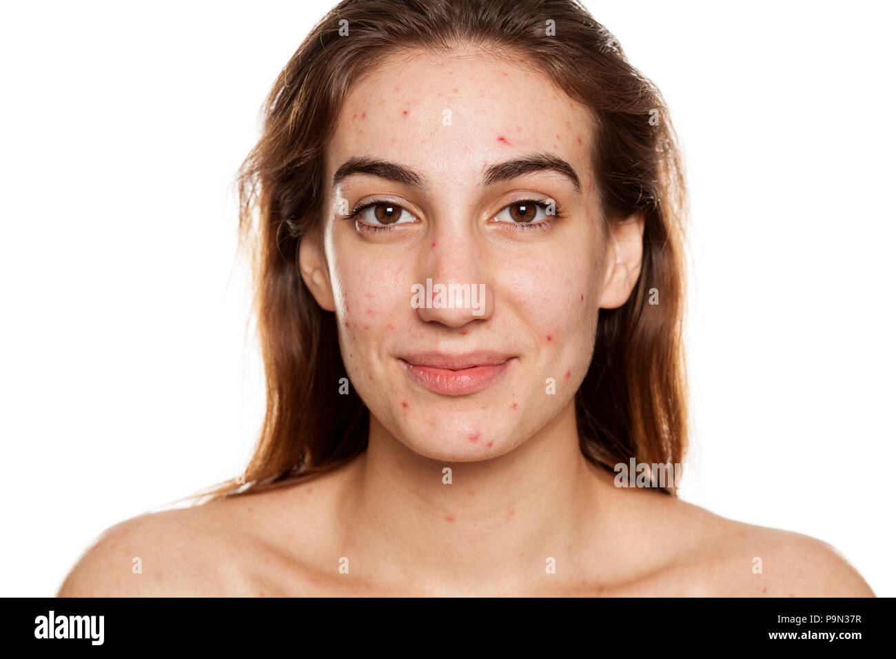 Junge lächelnde Frau mit problematischer Haut und ohne Make-up Posen auf weißem Hintergrund Stockfoto