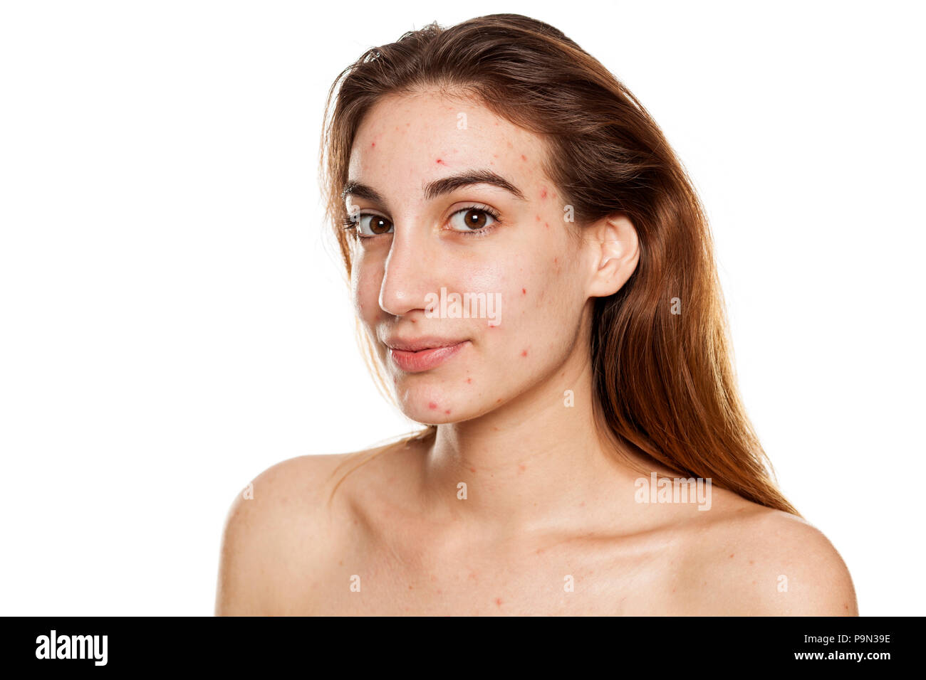 Junge lächelnde Frau mit problematischer Haut und ohne Make-up Posen auf weißem Hintergrund Stockfoto
