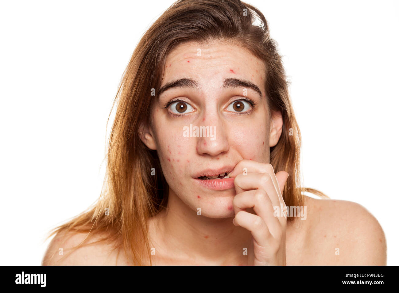 Junge besorgt Frau mit problematischer Haut und ohne Make-up Posen auf weißem Hintergrund Stockfoto