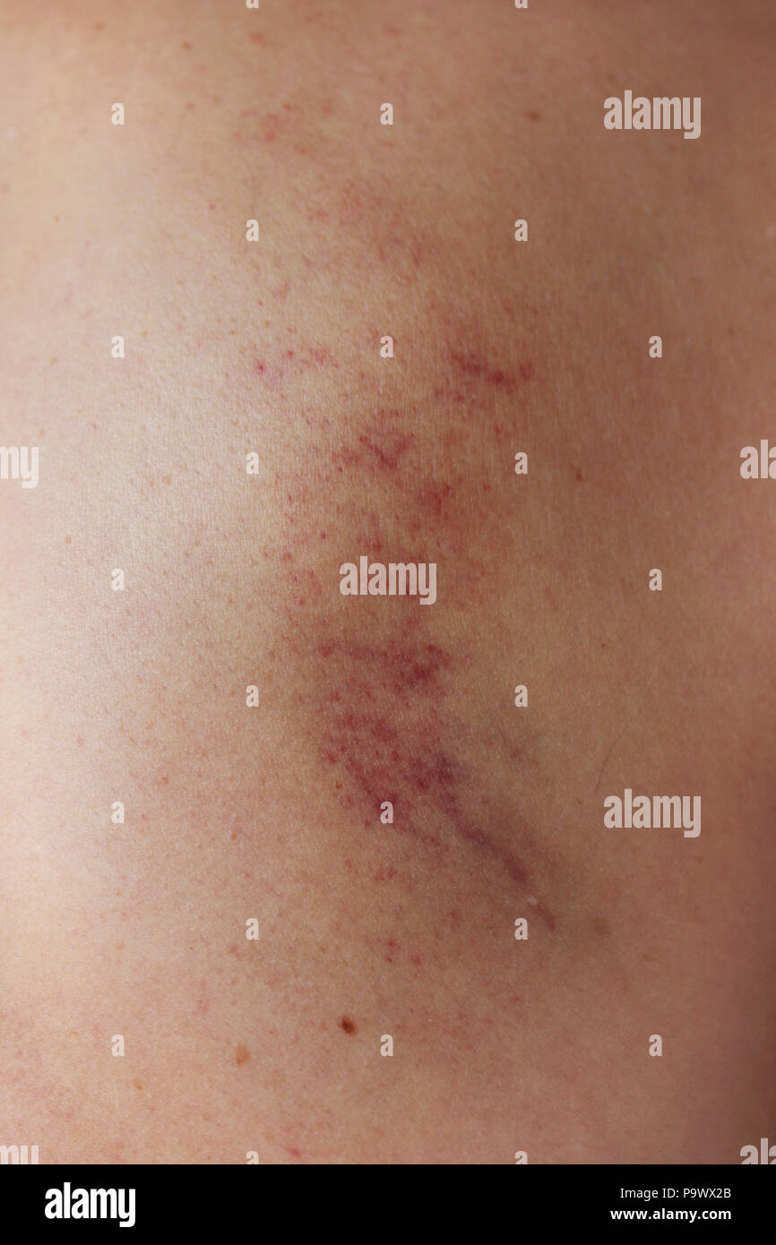 Blaue Flecken, die nach der alten Chinesischen Methode der Massage