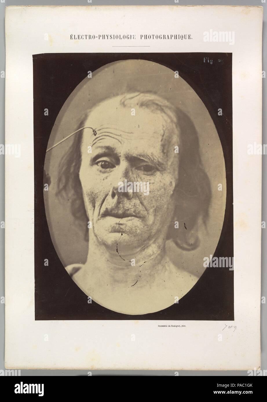 Abbildung 9: eine Studie von m. M. frontalis in maximaler Kontraktion. Artist: Guillaume-Benjamin-Amand Duchenne de Boulogne (Frankreich, 1806-1875); Adrien Tournachon (Französisch, 1825-1903). Abmessungen: Bild (Oval): 28,4 × 20,3 cm (11 3/16 x 8 in.) Blatt: 29,6 x 22,1 cm (11 5/8 x 8 11/16 in.) anbringen: 40,2 × 28,2 cm (15 13/16 x 11 1/8 in.). Datum: 1854-56, Gedruckt 1862. Museum: Metropolitan Museum of Art, New York, USA. Stockfoto