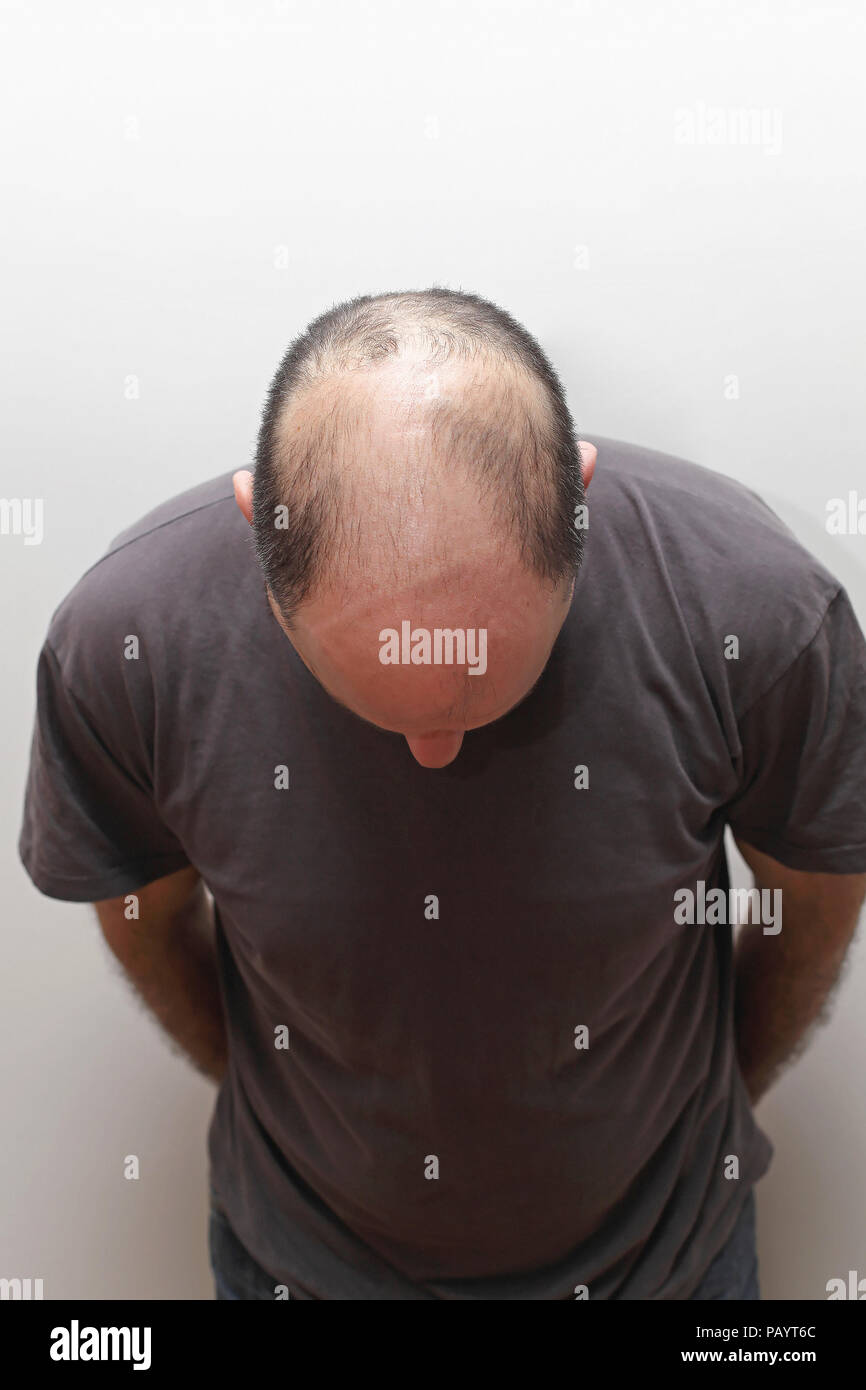 Draufsicht der Haarausfall Problem im mittleren Alter Mann Stockfoto