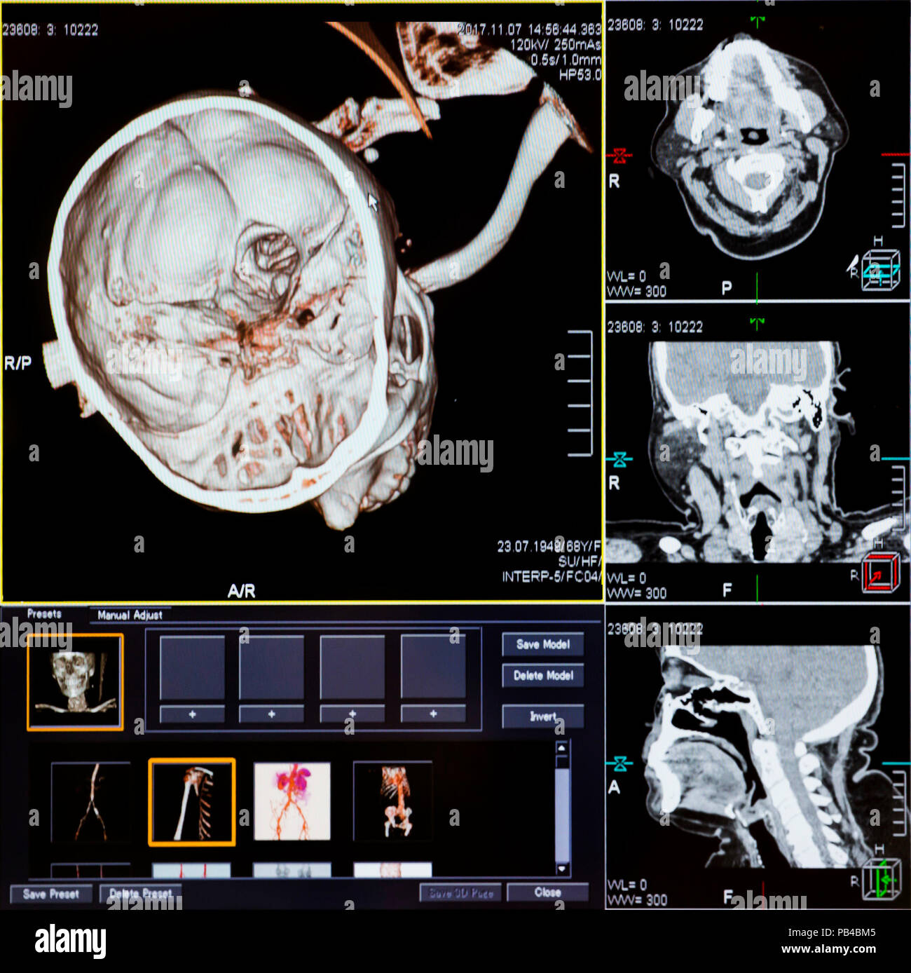 Die Magnetresonanztomographie (MRT) scan-CT Scans von menschlichen Kopf auf einem Ultraschall Computer überwachen. Stockfoto