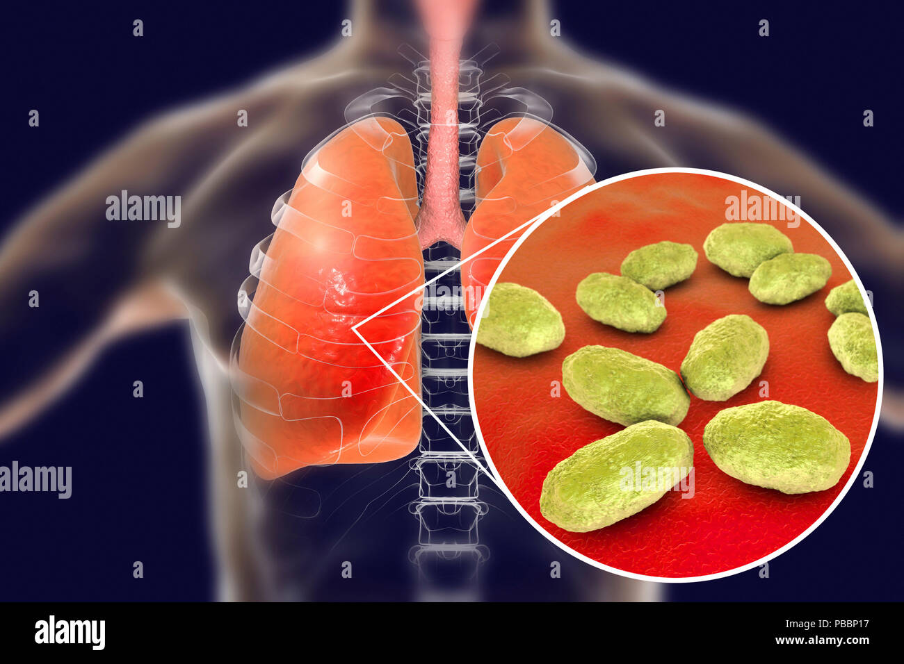 Pneumonie durch Haemophilus-influenzae-Bakterien, computer Abbildung verursacht. H. influenzae sind coccobacillus Gram-negative Bakterien. Diese Bakterien verursachen eine Anzahl von Krankheiten einschließlich Meningitis bei Kindern, Pneumonie, Osteoporose, Laryngitis, Konjunktivitis, neonatale Infektion, Otitis media (Mittelohrentzündung) und Sinusitis bei Erwachsenen. H. influenza harmlos der oberen Atemwege in den meisten Menschen kolonisieren innerhalb der ersten Monate des Lebens. Gekapselte Belastungen verbreitete Krankheiten wie Bronchitis und Lungenentzündung zu verursachen. Stockfoto