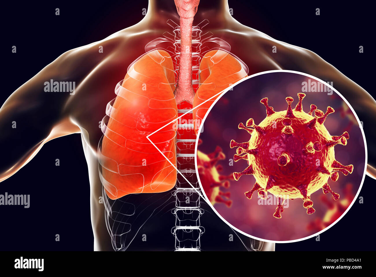 MERS virus Infektion der Lungen, konzeptionelle Darstellung. MERS (Naher Osten respiratorisches Syndrom) ist eine virale Erkrankung der Atemwege, die durch die MERS-assoziierten Coronavirus (MERS-CoV). Früher als neuartiges Coronavirus bekannt, MERS wurde zuerst in Saudi-Arabien im Jahr 2012 identifiziert. Die meisten Leute angesteckt mit MERS entwickeln schwere akute respiratorische Erkrankungen mit Symptomen wie Fieber, Husten und Kurzatmigkeit. Stockfoto