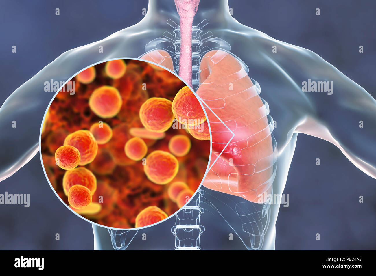 Lungenentzündung durch Mycoplasma pneumoniae Bakterien, konzeptionelle Computer Abbildung verursacht. Stockfoto