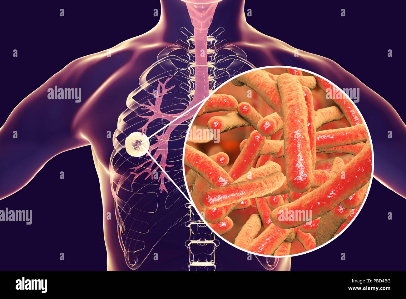 Faserig-höhlenartigen Lungentuberkulose und Nahaufnahme von Mycobacterium Tuberkulose, Bakterien, Erreger der Tuberkulose. Computer Abbildung: Cavern (Buchse) Im rechten Lungenflügel mit einem Wohlgeformten Faserschicht in seine Wand. Stockfoto