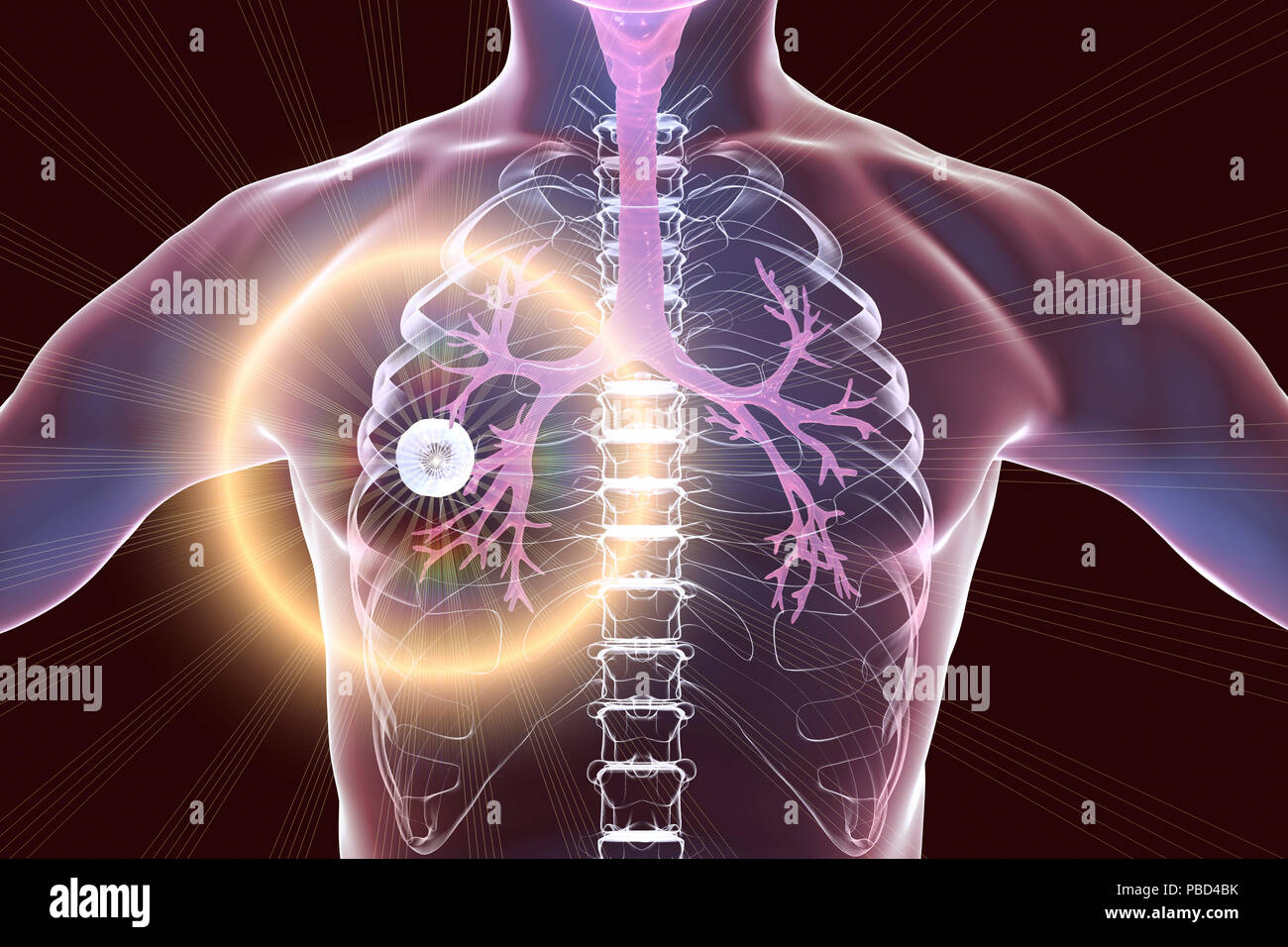 Vorbeugung und Behandlung der Lungentuberkulose, konzeptionelle Computer Abbildung. Markierte Höhle (Buchse) Im rechten Lungenflügel mit einem Wohlgeformten Faserschicht in seine Wand. Stockfoto
