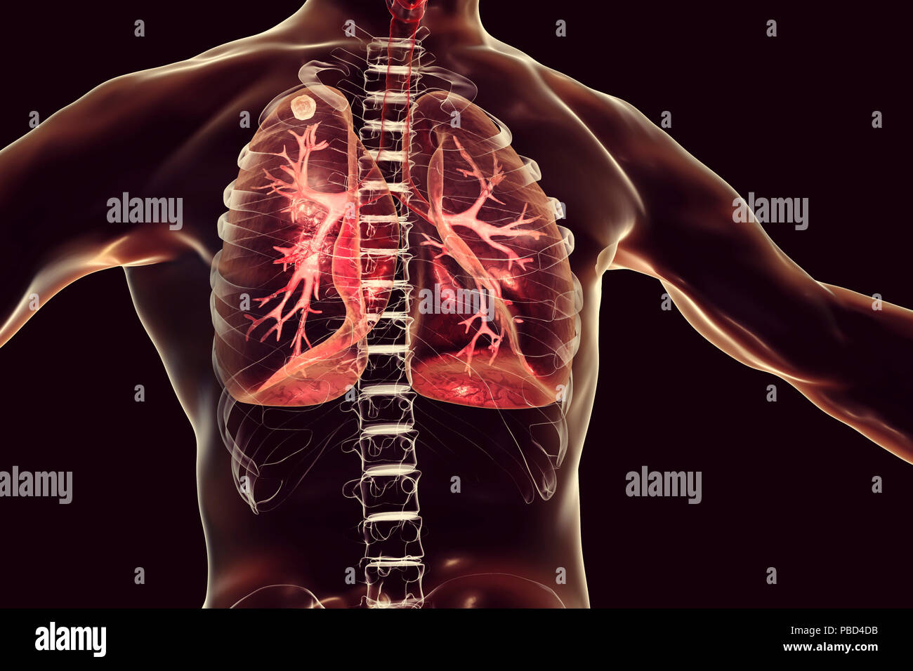 Sekundäre Tuberkuloseinfektion. Computer Abbildung kleine - große Feste noduläre Masse im oberen Lungenlappen rechten Lungenflügel in der Nähe der Lunge Apex entfernt. Stockfoto