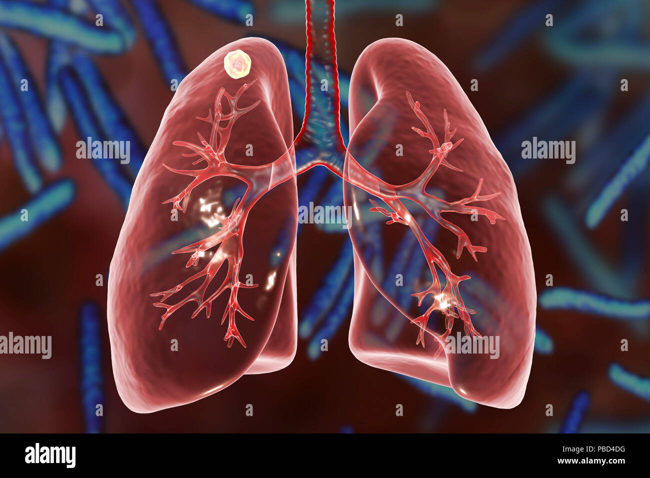 Sekundäre Tuberkuloseinfektion. Computer Abbildung kleine - große Feste noduläre Masse im oberen Lungenlappen rechten Lungenflügel in der Nähe der Lunge Apex entfernt. Bild Hintergrund stellt Abbildung von Mycobacterium Tuberkulose, Bakterien, Erreger der Tuberkulose. Stockfoto