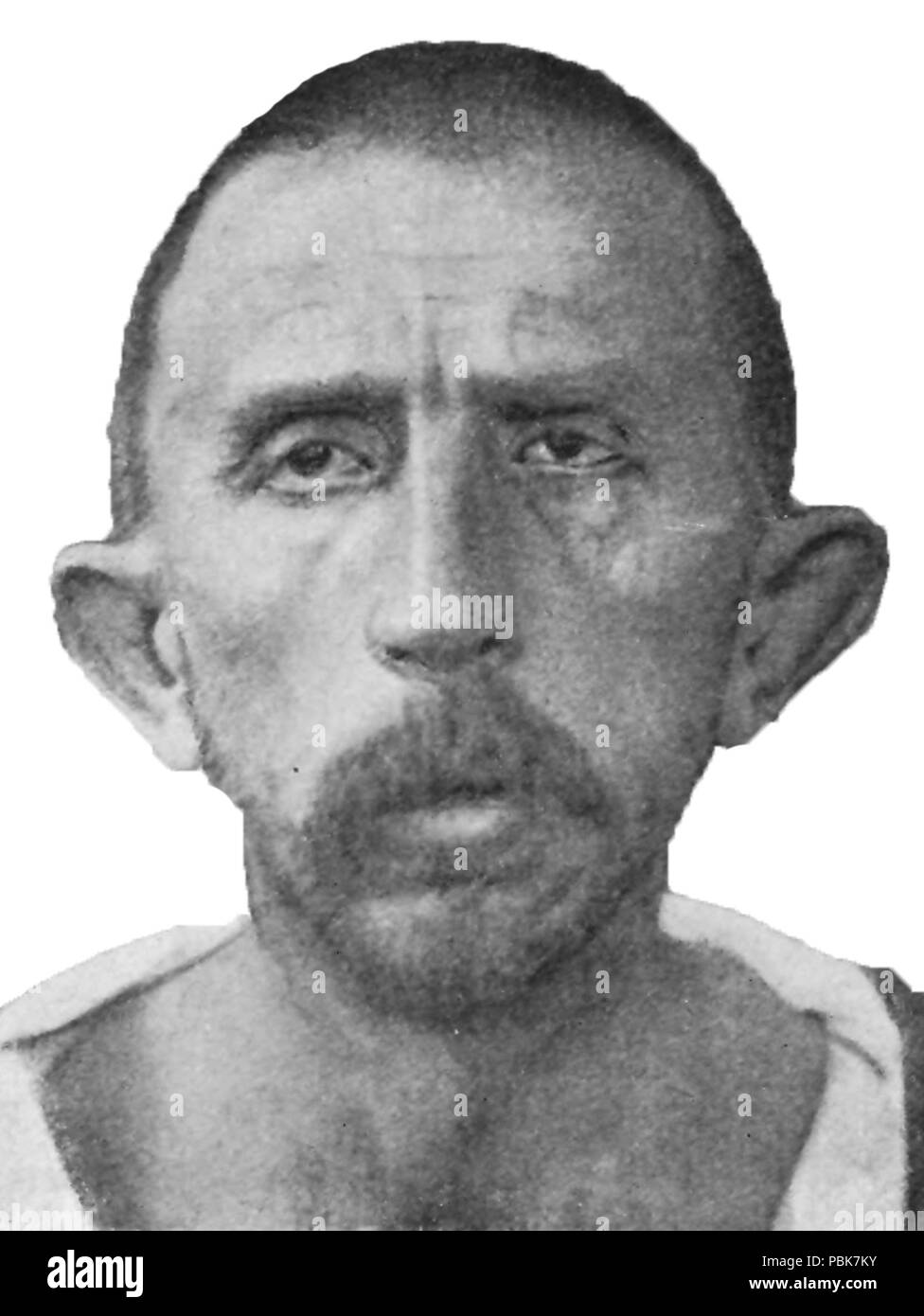 1295 Schizophrenie angeborene Idiot, Alter 39. Asthenische v2 Stockfoto