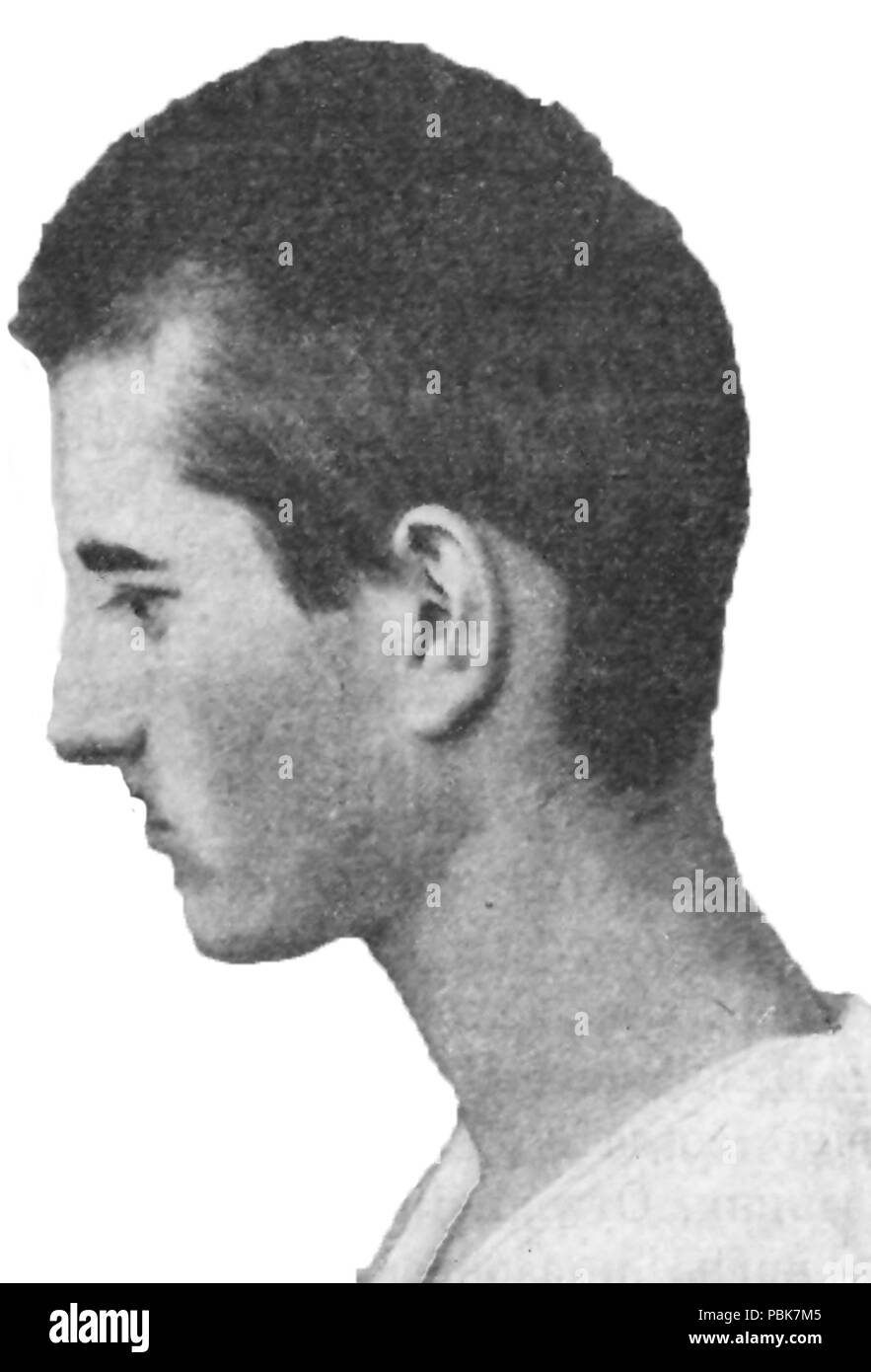 1908 "Pelz-cap Hair"-Asthenische Schizophren, Alter 21. Stockfoto