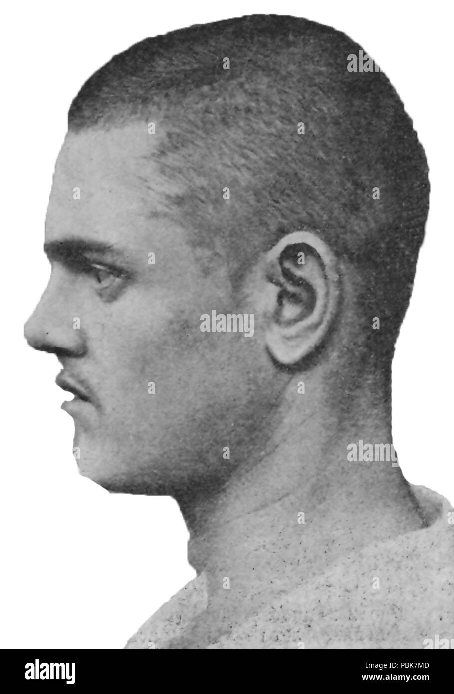 779 Hypoplastischen Gesicht. Epilepsie, Alter 20 - Profil Stockfoto
