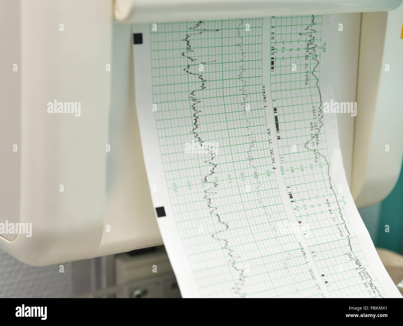 Monitor für die Messung von Kontraktionen, Herzschlag einer schwangeren Frau Stockfoto