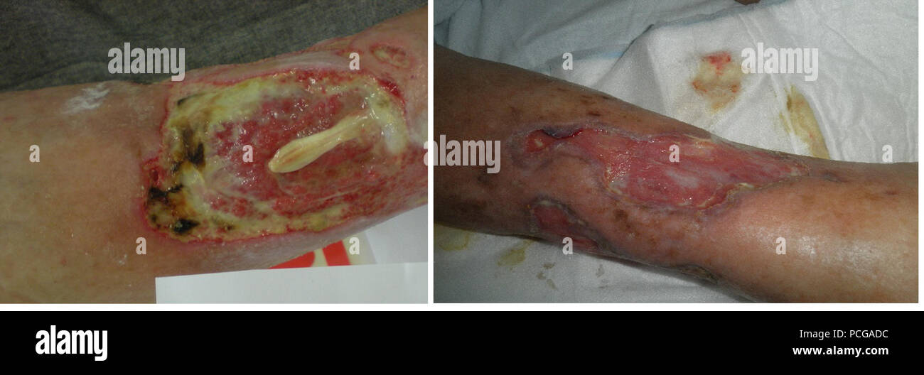 130 Chronická rána pacienta před ein po ukončení Studie Stockfoto
