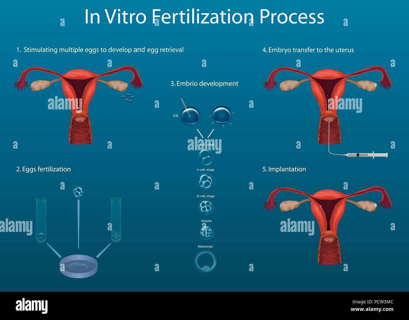 In-vitro-Fertilisation (IVF), Illustration. Stockfoto