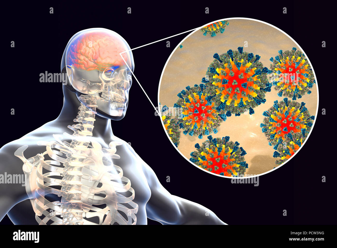 Enzephalitis durch Masern Viren, computer Abbildung verursacht. Dieses Virus aus der Gruppe der Viren Morbillivirus, besteht aus einem RNA (Ribonukleinsäure) Kern durch einen Umschlag mit oberflächenproteine Hämagglutinin und Neuraminidase und Fusion Protein, die verwendet werden, um und durchdringen eine Wirtszelle zu befestigen umgeben. Masern ist eine hoch ansteckende juckender Hautausschlag mit Fieber. Es betrifft vor allem Kinder und einen Angriff Normalerweise gibt lebenslange Immunität. Enzephalitis ist eine der Komplikationen einer Maserninfektion. Stockfoto