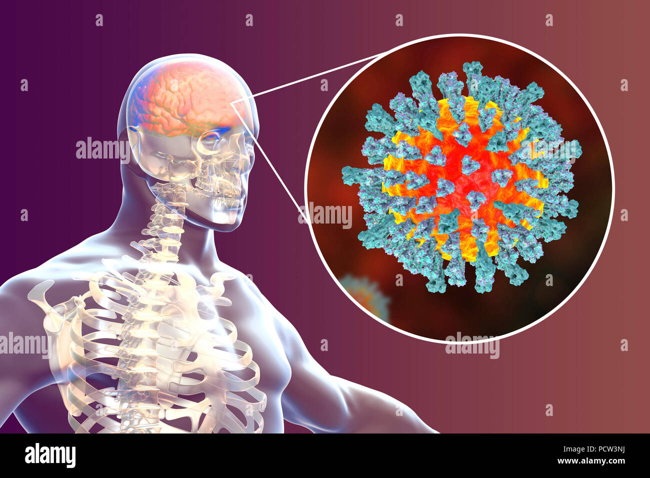 enzephalitis durch masern viren computer abbildung verursacht dieses virus aus der gruppe der viren morbillivirus besteht aus einem rna ribonukleinsaure kern durch einen umschlag mit oberflachenproteine hamagglutinin und neuraminidase und fusion