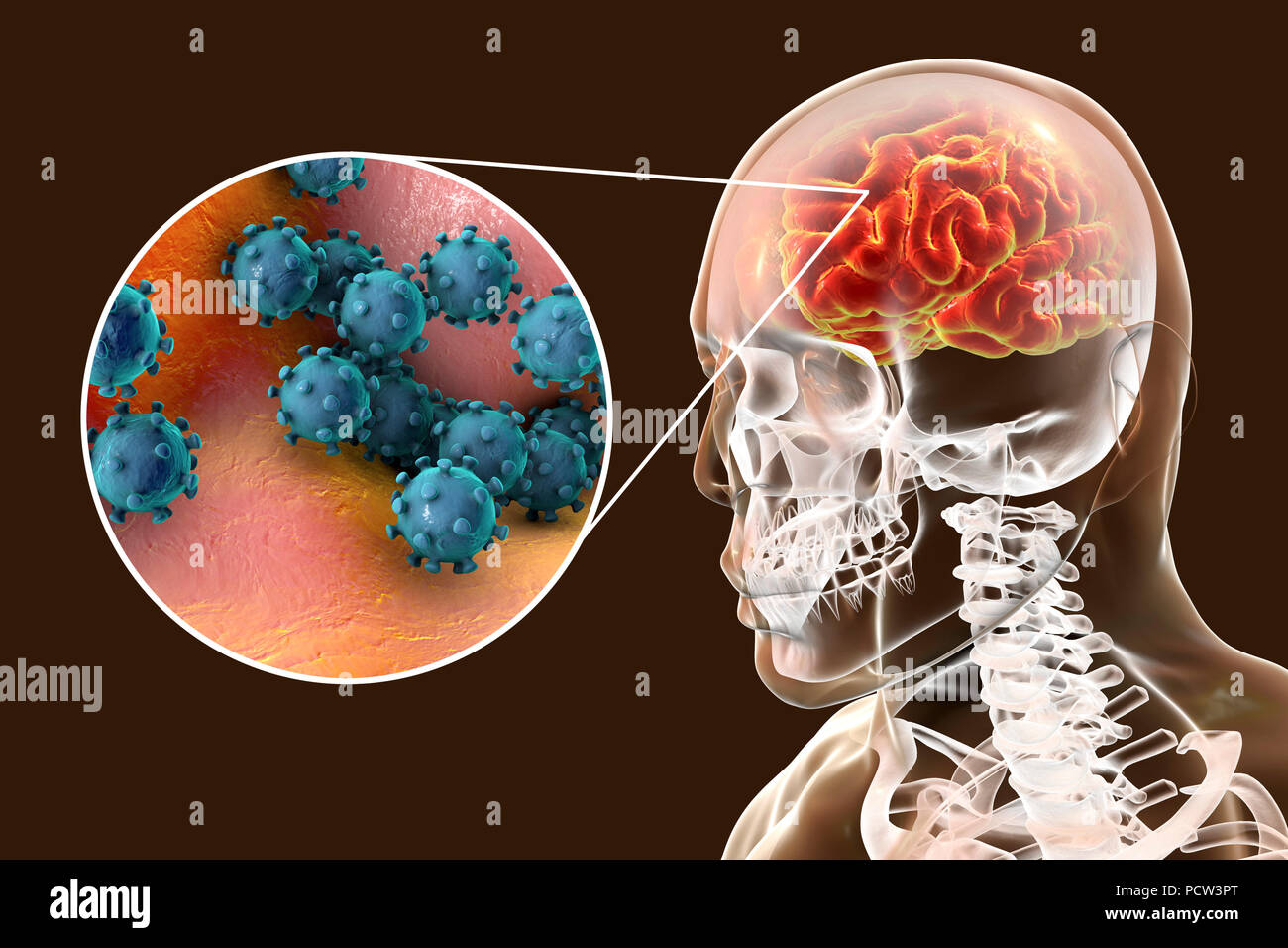 Virale Enzephalitis. Konzeptionelle Abbildung: Gehirn mit Anzeichen von Enzephalitis innerhalb der menschlichen Körper und Nahaufnahme von Viren. Stockfoto