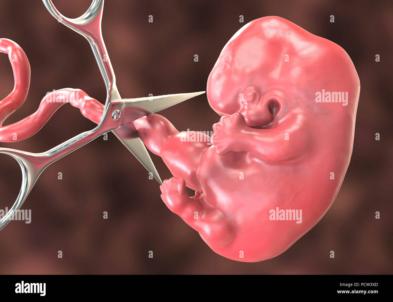 Abtreibung, konzeptionelle Darstellung. Medizinisches instrument Durchtrennen der Nabelschnur zu einem Embryo. Stockfoto