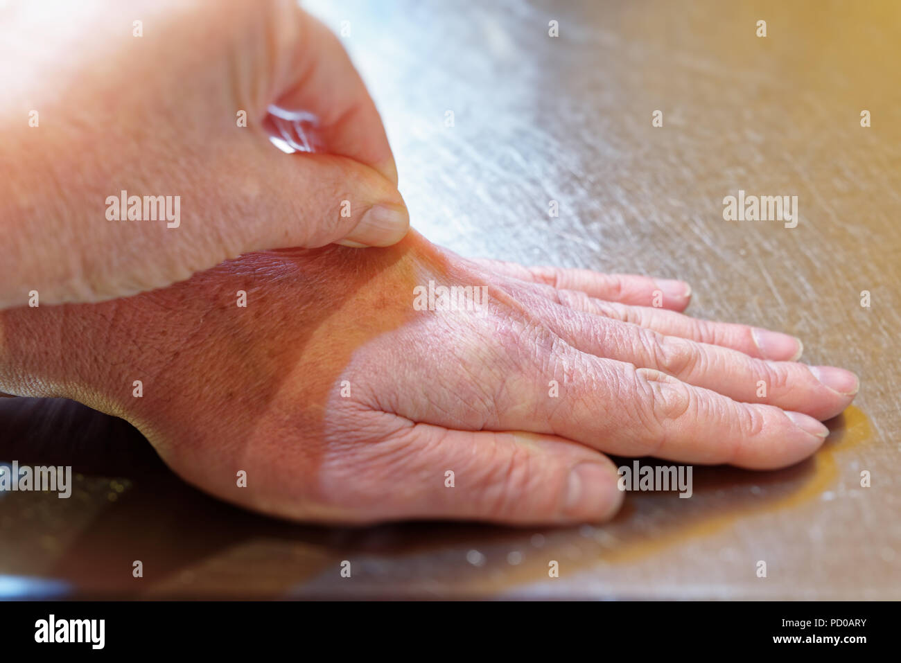Ziehen Sie die Haut auf der Rückseite der Hand die Haut turgor zu prüfen, ob Symptome einer Dehydratation Stockfoto