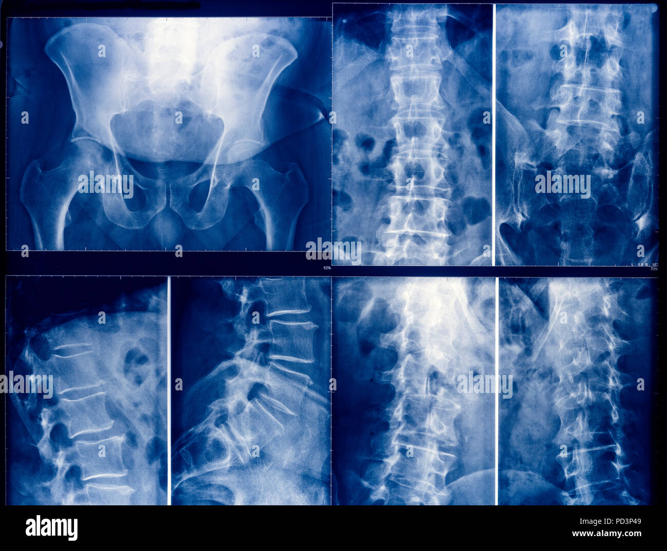 Blau X-ray Bilder eines menschlichen Becken und Wirbelsäule Stockfoto