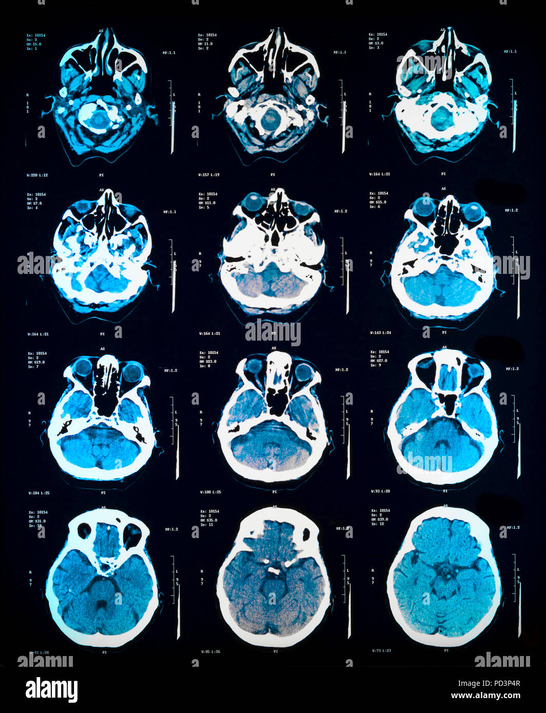 Reihenfolge der horizontale Abschnitte eines weiblichen menschlichen Gehirn, MRI-Scans, Magnetresonanztomographie, Stockfoto