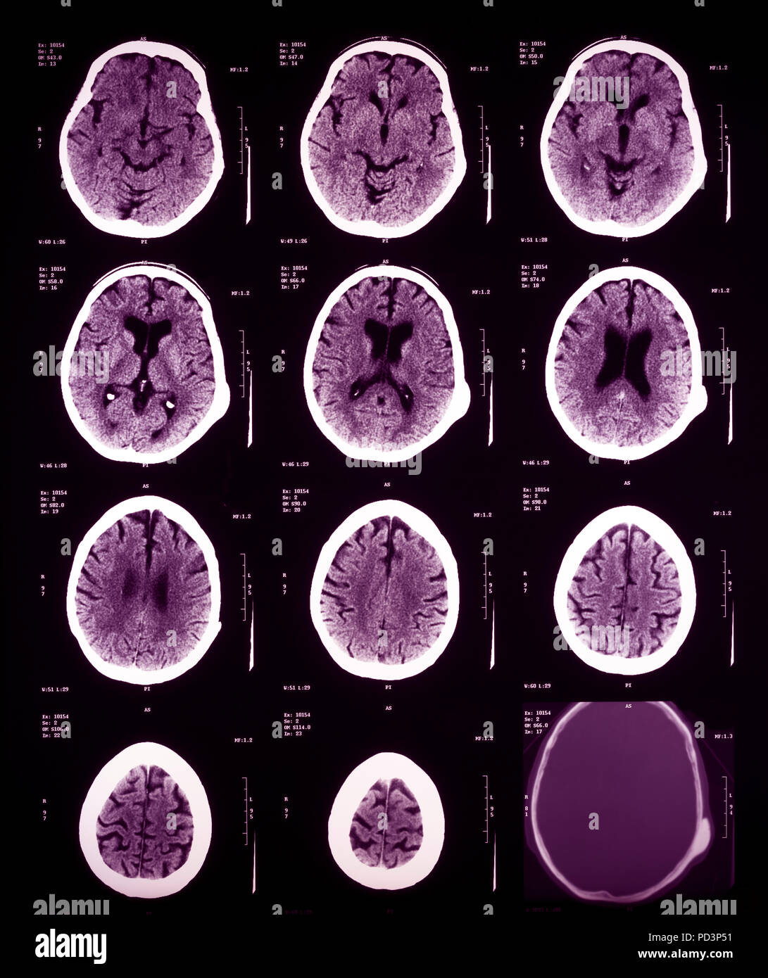 Reihenfolge der horizontale Abschnitte eines weiblichen menschlichen Gehirn, MRI-Scans, Magnetresonanztomographie, Stockfoto