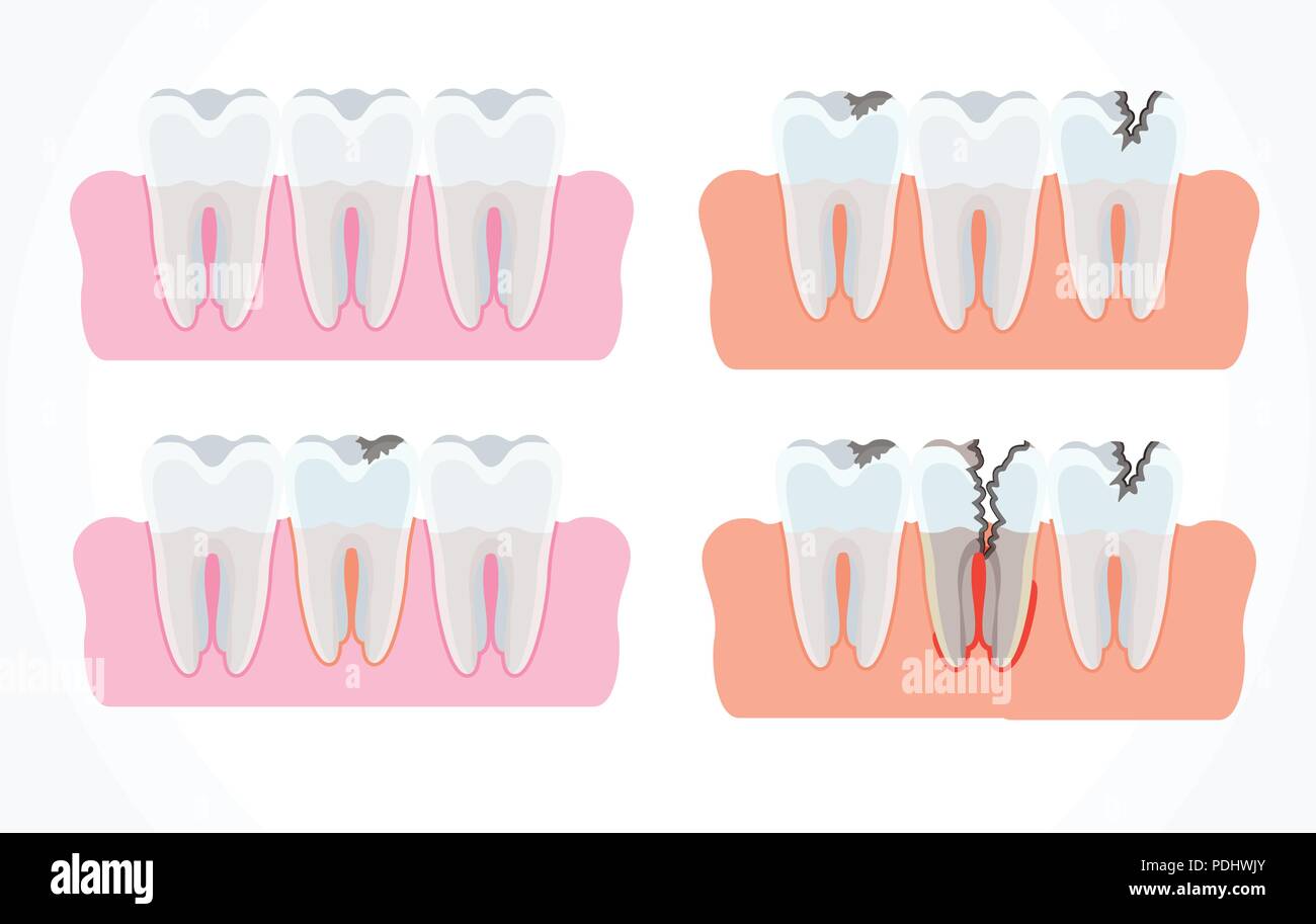 Phasen der Karies mit Karies. Zahn- und Mundpflege Stock Vektor