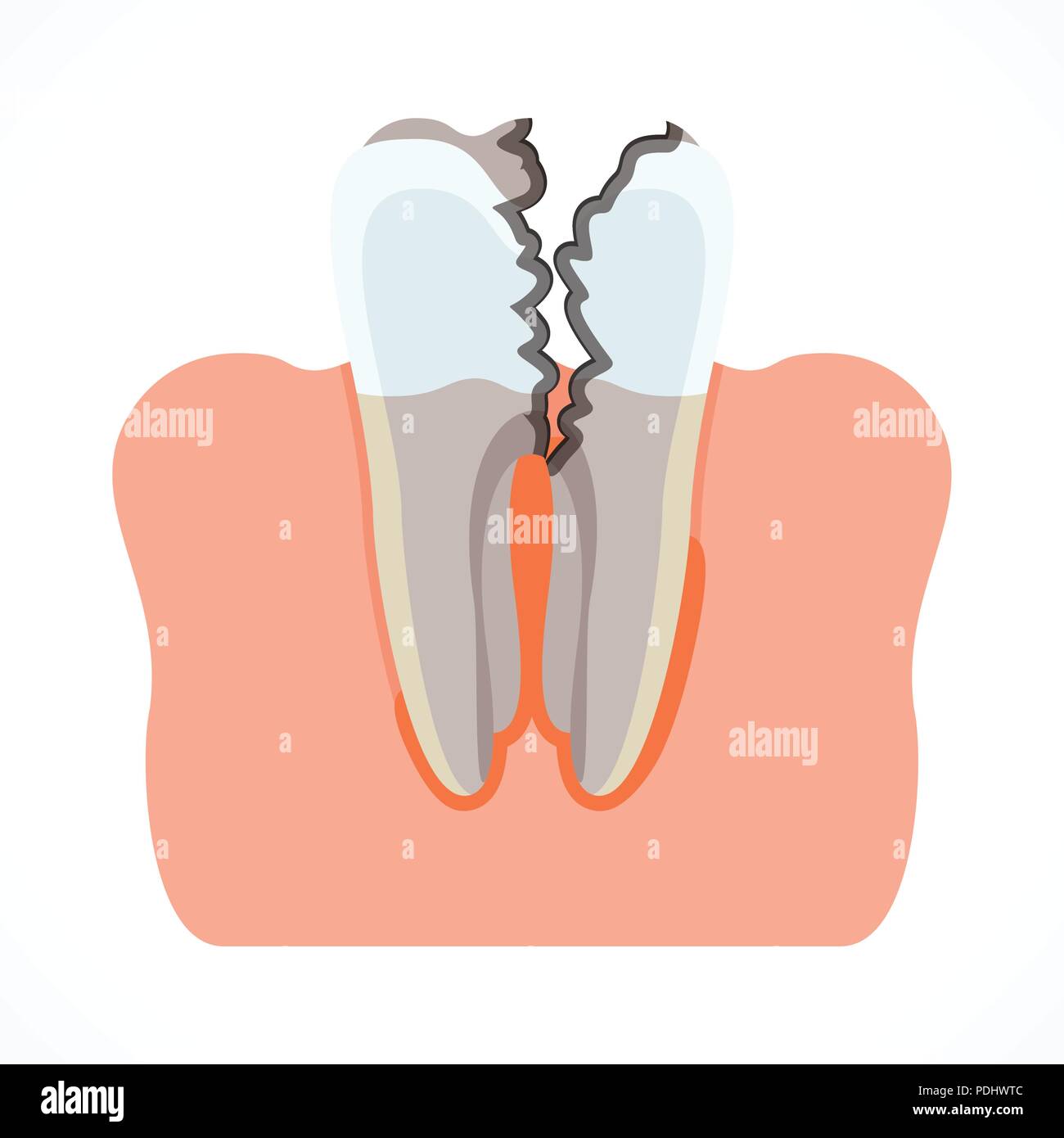 Phasen der Karies mit Karies. Zahn- und Mundpflege Stock Vektor