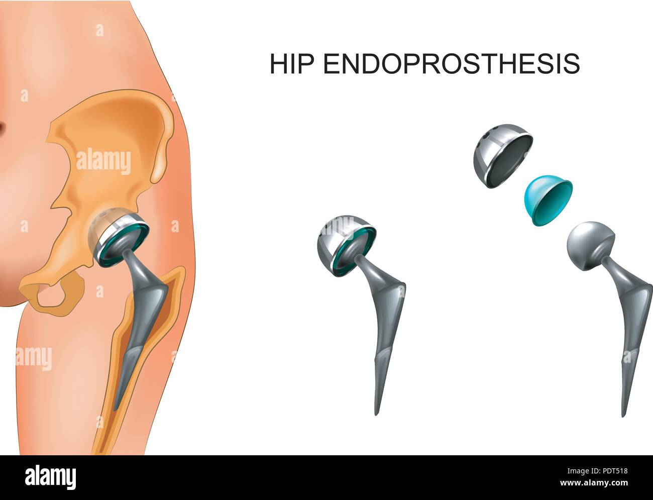 Vector Illustration der weiblichen Hüfte und Hüftprothese. Chirurgie. Stock Vektor