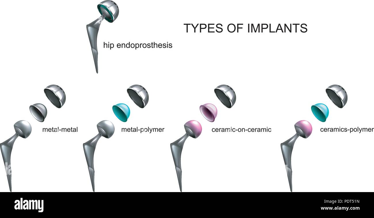 Vector Illustration der Typen von Implantaten durch die Art des Materials, Stock Vektor