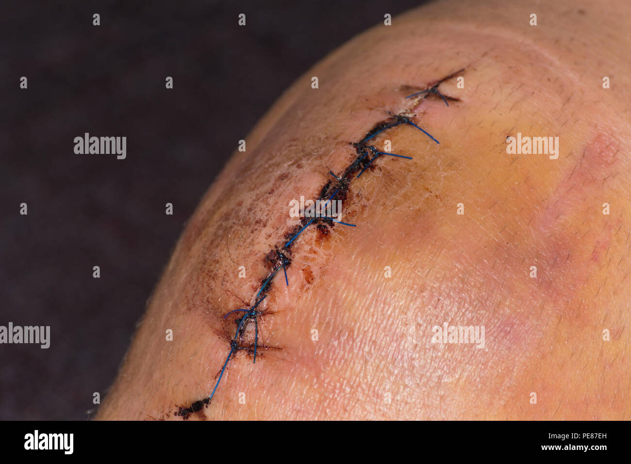 Männliche Knie nach dem chirurgischen Eingriff, Kniegelenkersatz. Kniechirurgie im Krankenhaus Stockfoto