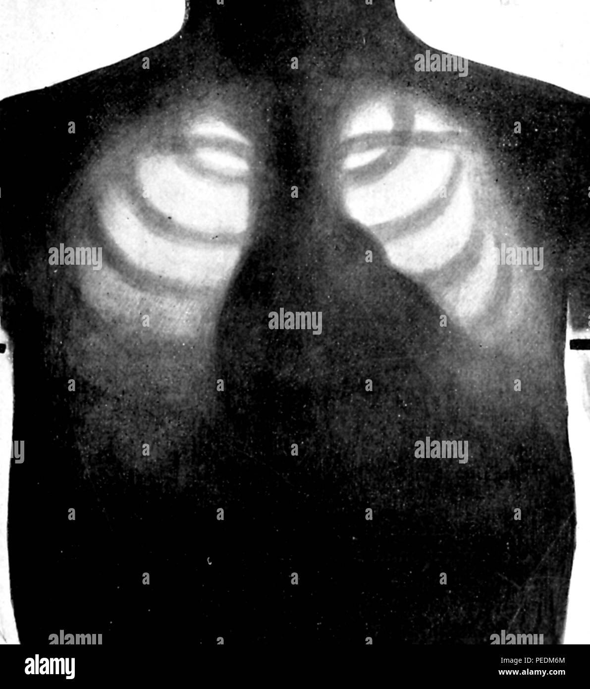 Schwarze und weiße Röntgenaufnahme eines Patienten mit 'passive Staus in den Lungen von valvular Disease," von der Band "Die Röntgen Strahlen in Medizin und Chirurgie als Hilfe bei der Diagnose und als Therapeutikum,' von Francis H (Francis Henry) Williams, und in New York von der Macmillan Company, 1903 veröffentlicht verfasst. Mit freundlicher Genehmigung Internet Archive. () Stockfoto