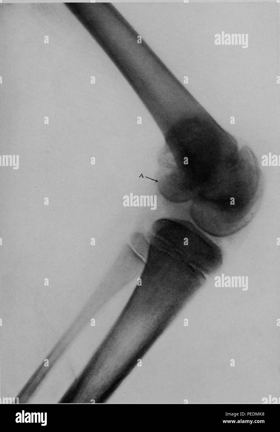 Schwarze und weiße X-ray oder Rontgen ray zeigt eine Verschiebung des unteren Ende des Oberschenkels in ein 10 Jahre alter Mann, 1910. Mit freundlicher Genehmigung Internet Archive. () Stockfoto