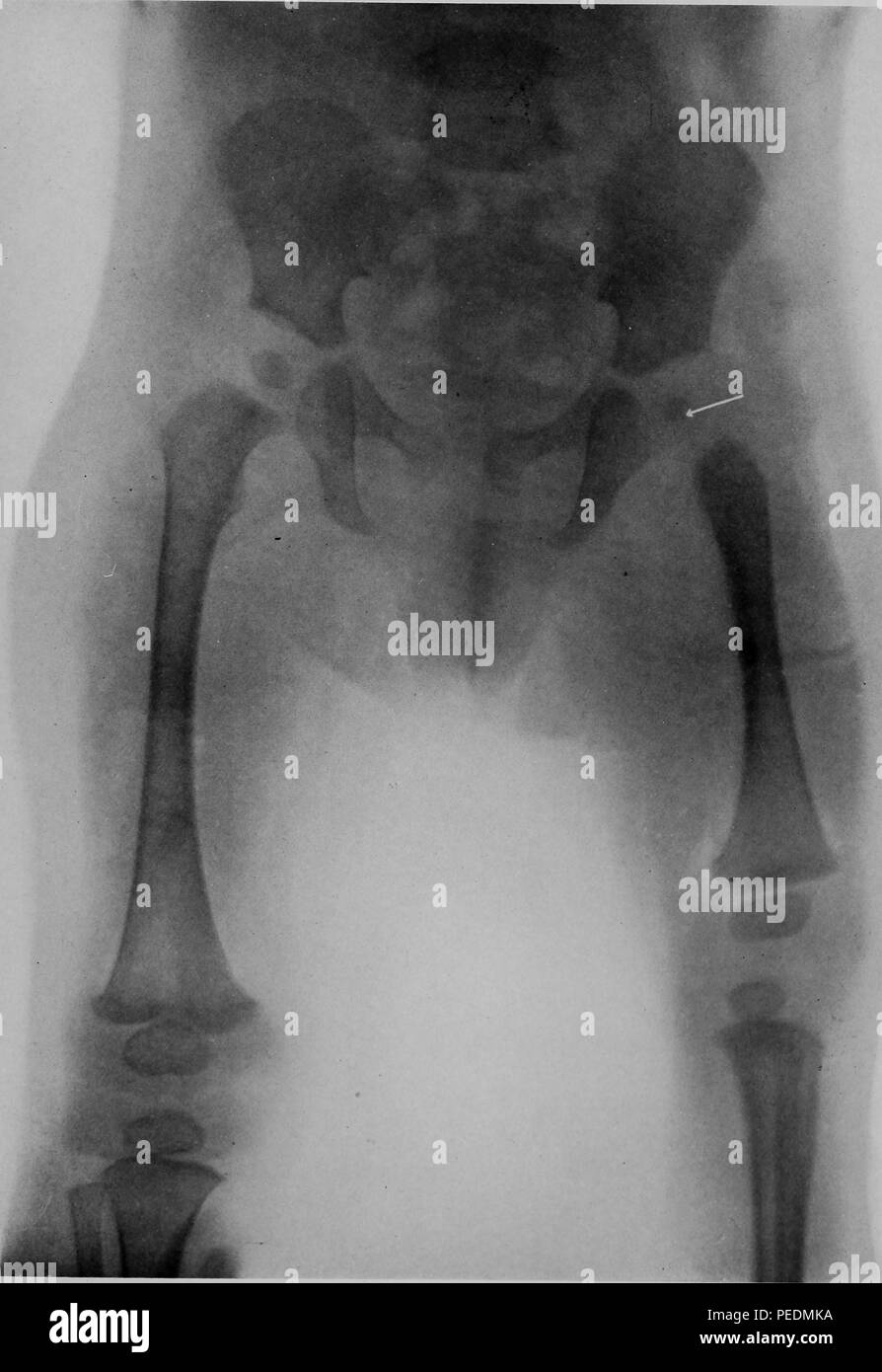 Schwarze und weiße X-ray oder rontgen Ray, die die angeborene verzögerte Entwicklung des rechten Beines in einem sechs Monate alten, 1910. Mit freundlicher Genehmigung Internet Archive. () Stockfoto