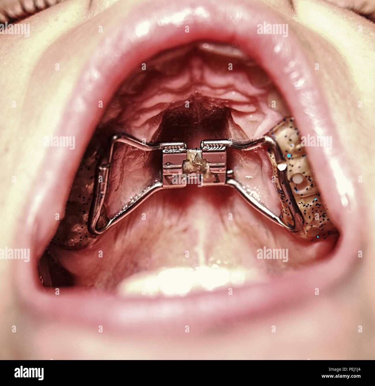 Kid tragen Kieferorthopädische palatal Expansion Trainer. Unsichtbare Zahnspangen Ausrichter. Beliebte kieferorthopädische Geräte, die für die Geburt zahnmedizinische deffect Stockfoto