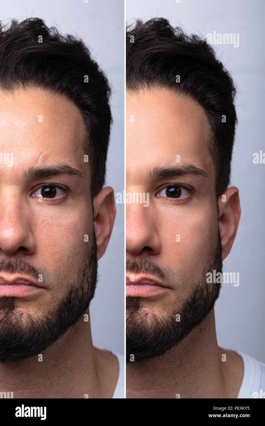 Der Mann Gesicht vor und nach der kosmetischen Verfahren auf grauem Hintergrund Stockfoto