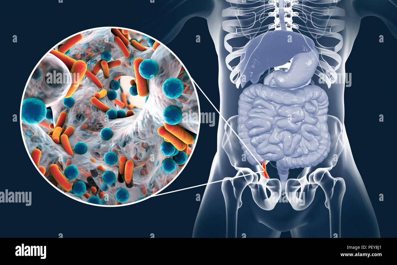 Blinddarmentzündung. Abbildung eines menschlichen Anhang, zeigt es rot und entzündet in blinddarmentzündung und eine Nahaufnahme von Bakterien, die Erreger der Blinddarmentzündung. Die häufigsten Mikroorganismen aus der Anlage mit akuter Blinddarmentzündung zurückgewonnen werden Escherichia coli, Bacteroides sp., die weniger häufig zu finden sind, Klebsiella pneumoniae Streptococcus sp. Enterococcus sp. Pseudomonas aeruginosa und andere Bakterien. Stockfoto