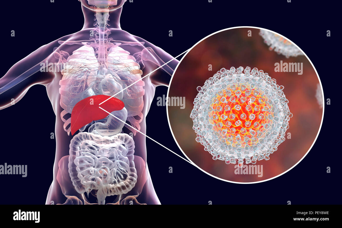 Hepatitis-C-Infektion. Computer Abbildung mit der Leber und eine Nahaufnahme von Hepatitis C-Viren. Stockfoto