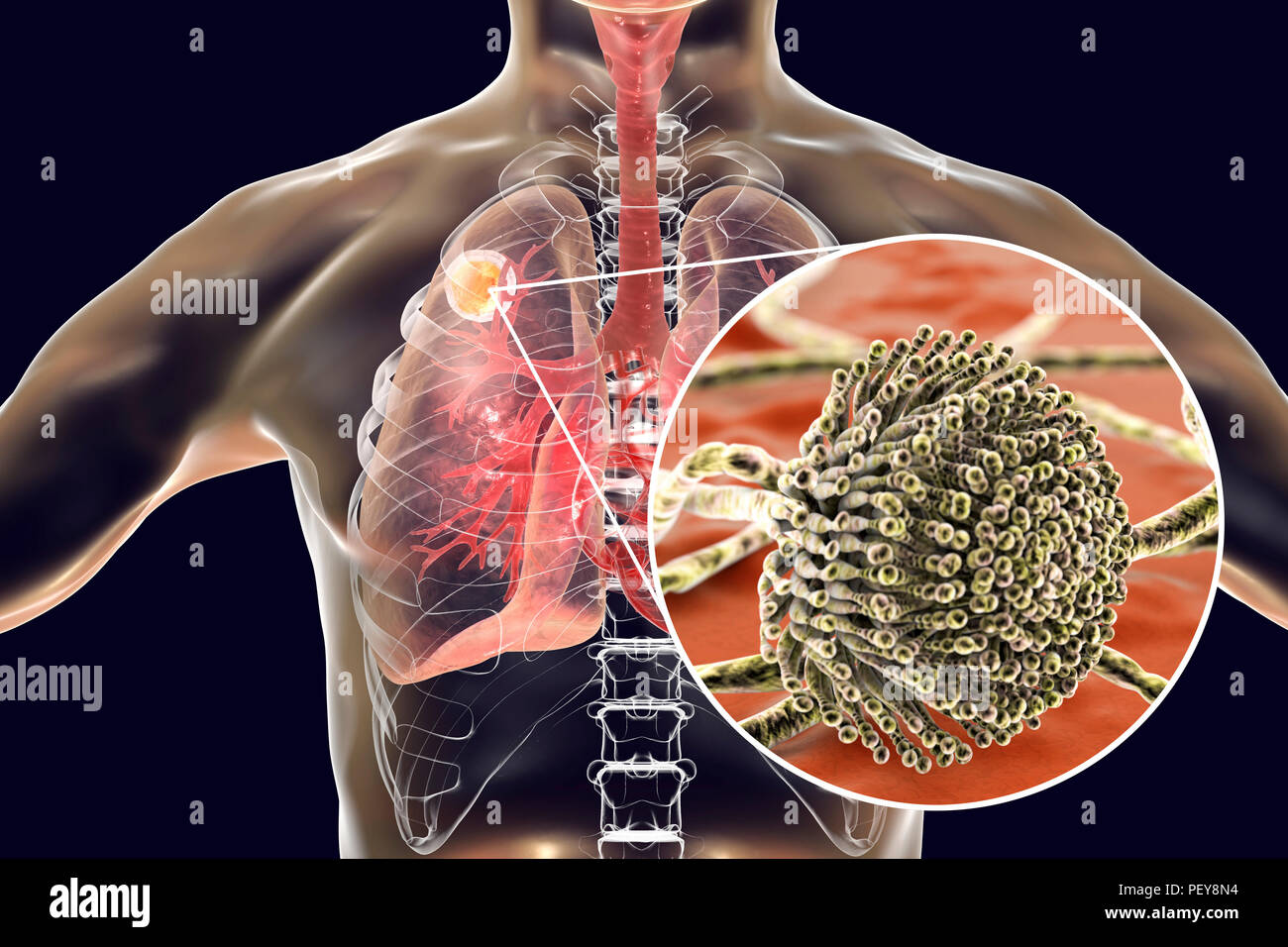 Aspergilloma der Lunge und eine Nahaufnahme von Aspergillus Pilze, computer Abbildung. Auch als myzetom oder Pilz ball bekannt, ist dies ein intrapulmonary Läsion durch Aspergillus Pilze bei immunsupprimierten Patienten hergestellt. Stockfoto