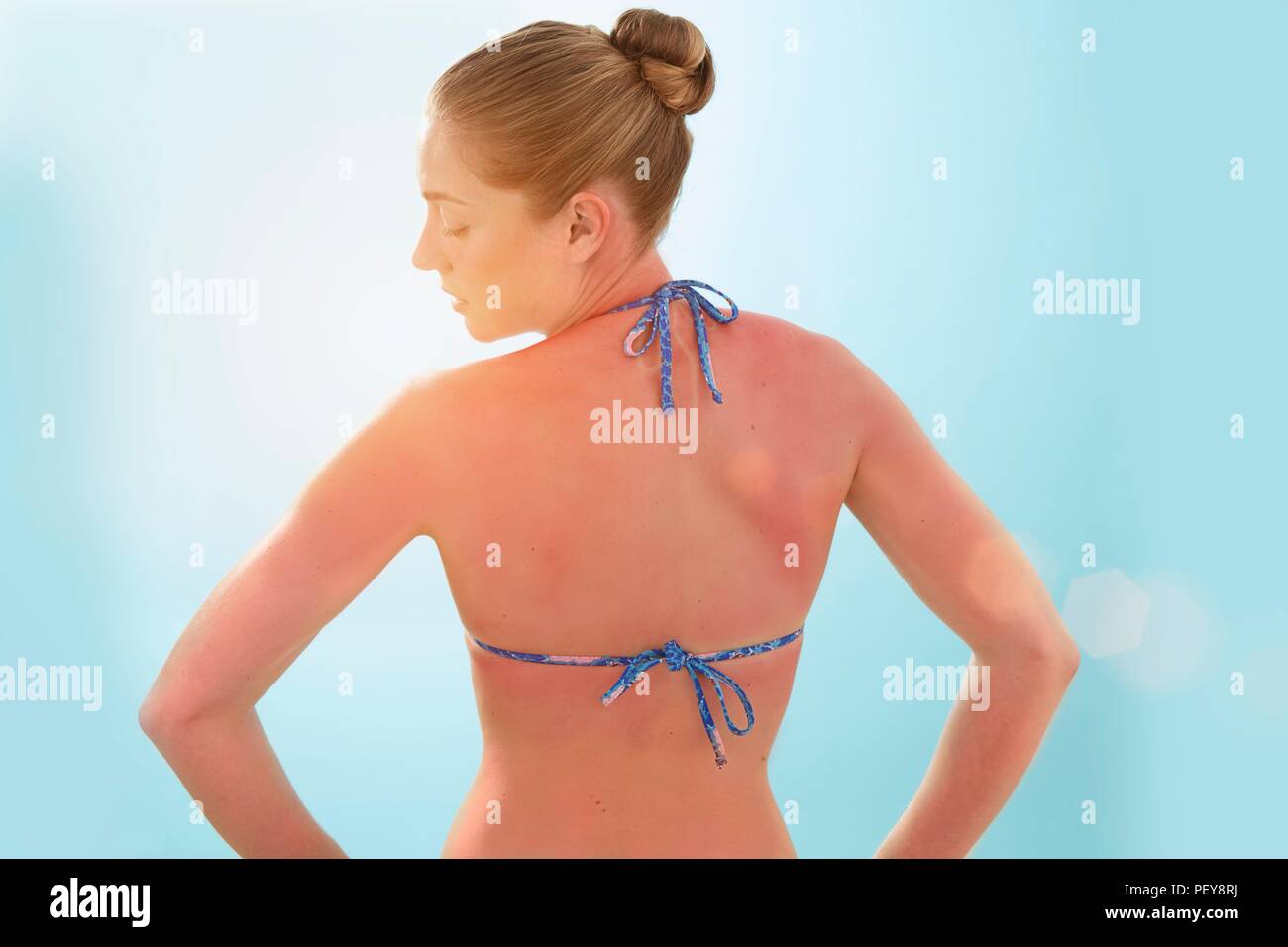 Frau mit Sonnenbrand zurück, Ansicht von hinten. Stockfoto