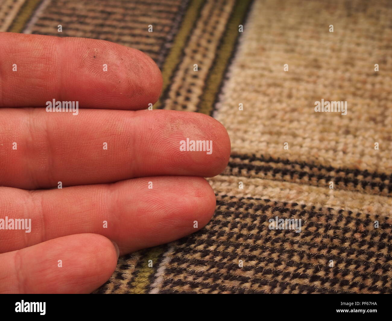 Verbrennungen auf der Haut der Finger.