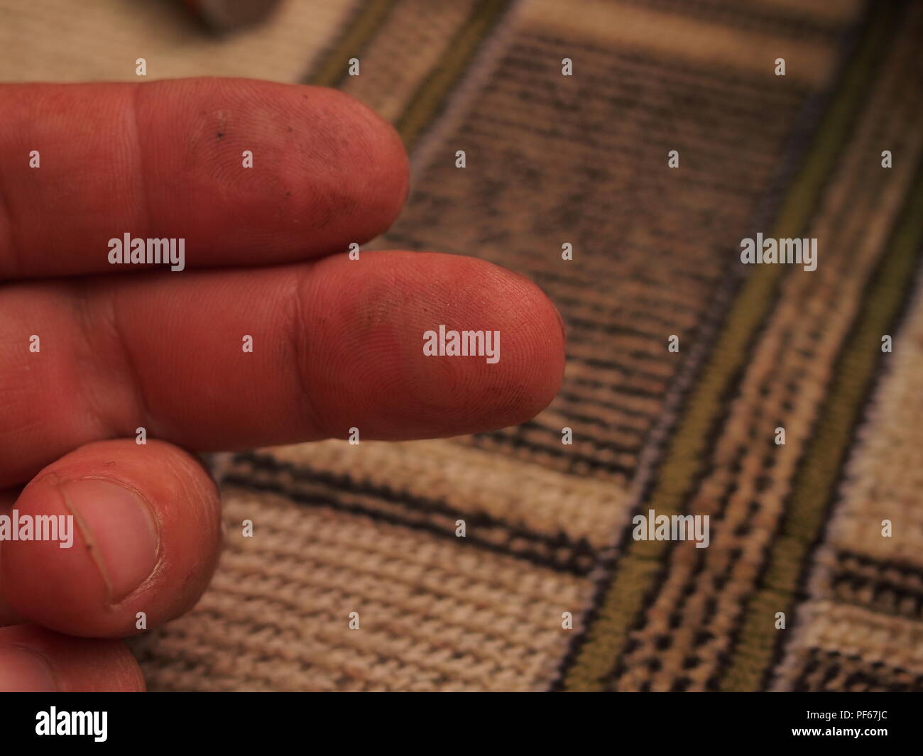 Was Hilft Bei Verbrennungen Am Finger www.alamy.de