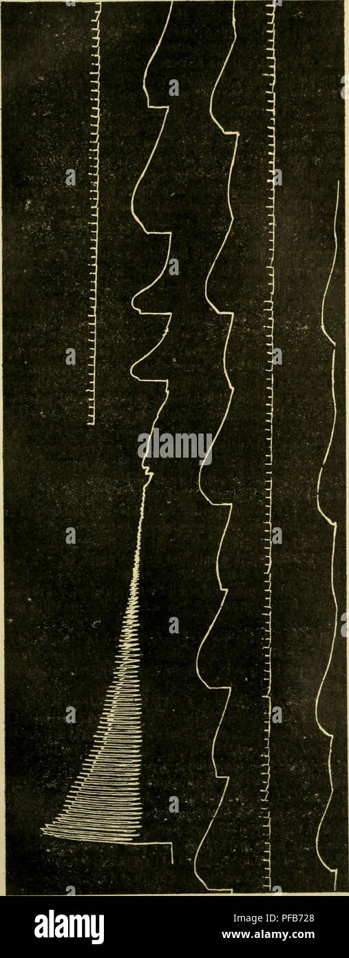 . Wörterbuch de Physiologie. Physiologie. n Müdigkeit.. 3 5 - 2 - 5 Ã¢) nebenklägerin reprÃ©sente La Fa - ich igue nÃ©vro-Musculaire; La seconde reprÃ©sente les Kontraktionen et la Fa tigue Idio-Musculaire. Dans la première Partie du tracÃ©, nous voyons une sÃ©rie de Contrac- tionen, La fermeture et la Bruch, se suivant À deux Sekunden d'in-tervalle (Courant ascen-ter). Mais le Muskel ne Reste pas relÃ¢ chÃ© dans les Intervalles de Erregungen. Einrichtung ¨ s La pre-miÃ¨re Kontraktion, le Muskel beschuldigen un-CER-tain degrÃ© de raccour - cissement qu'il conser-vera jusqu'à la fin: c'est le Gal - raccourcissement Stockfoto