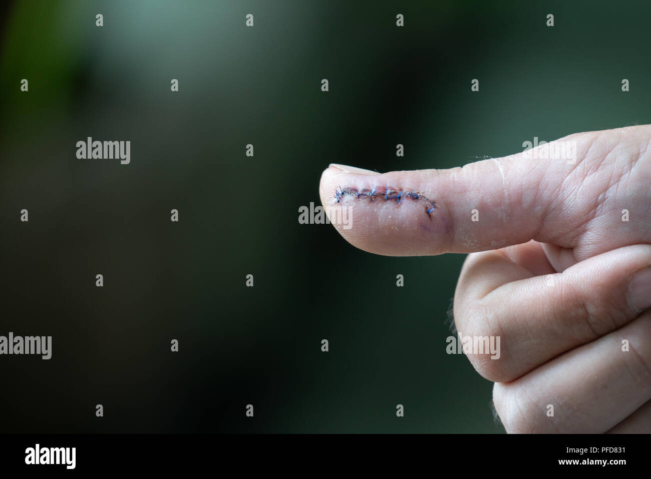 Hand mit Stichen von Operation zu Schäden reparieren Stockfoto
